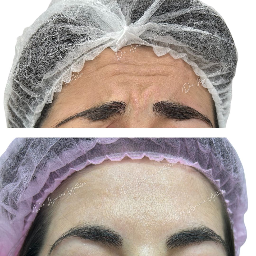 Resultado botox Padre Hurtado — Dra. Azucena Montilla