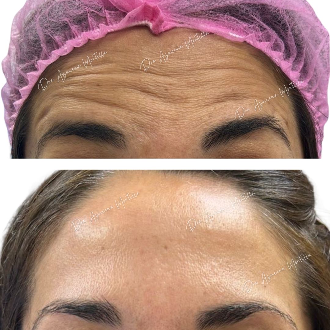 Resultado botox Padre Hurtado — Dra. Azucena Montilla