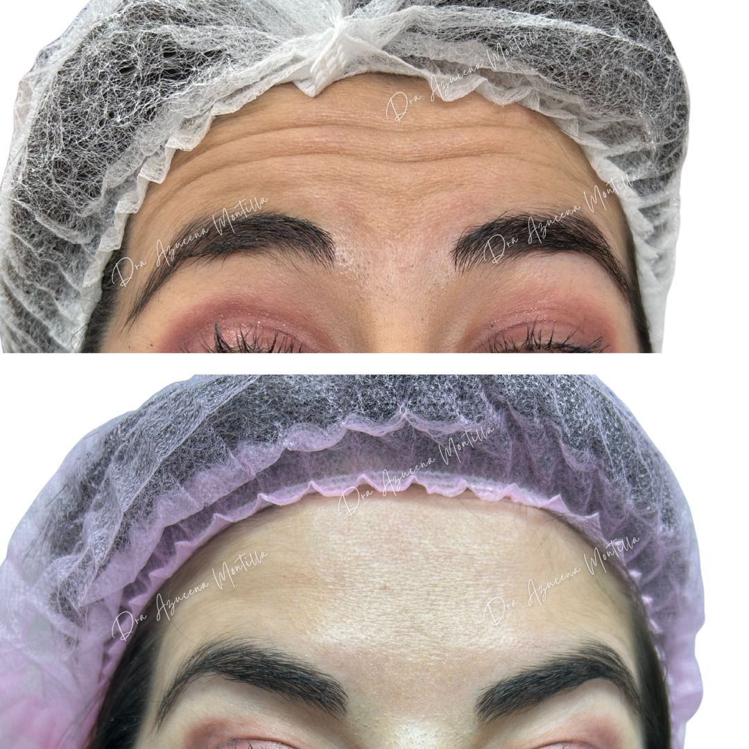 Resultado botox Padre Hurtado — Dra. Azucena Montilla