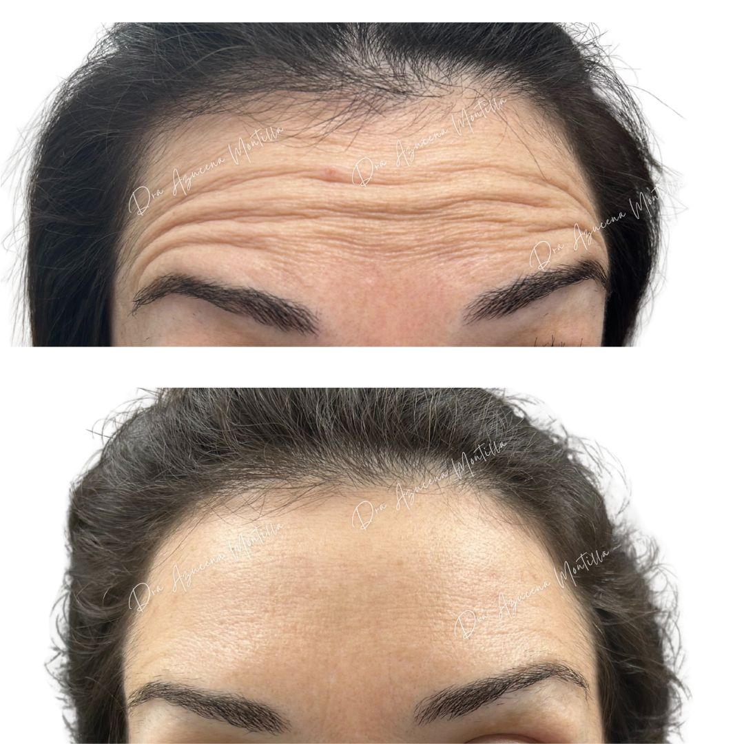 Resultado botox Padre Hurtado — Dra. Azucena Montilla