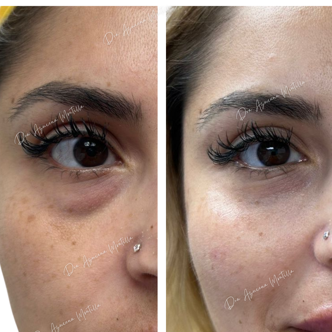 Tratamiento de ojeras con ácido hialurónico en Padre Hurtado — Dra. Azucena Montilla