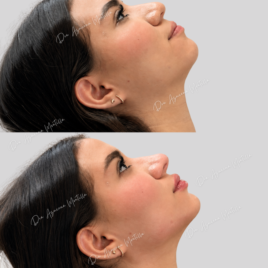 Armonización facial con ácido hialurónico en Padre Hurtado — Dra. Azucena Montilla
