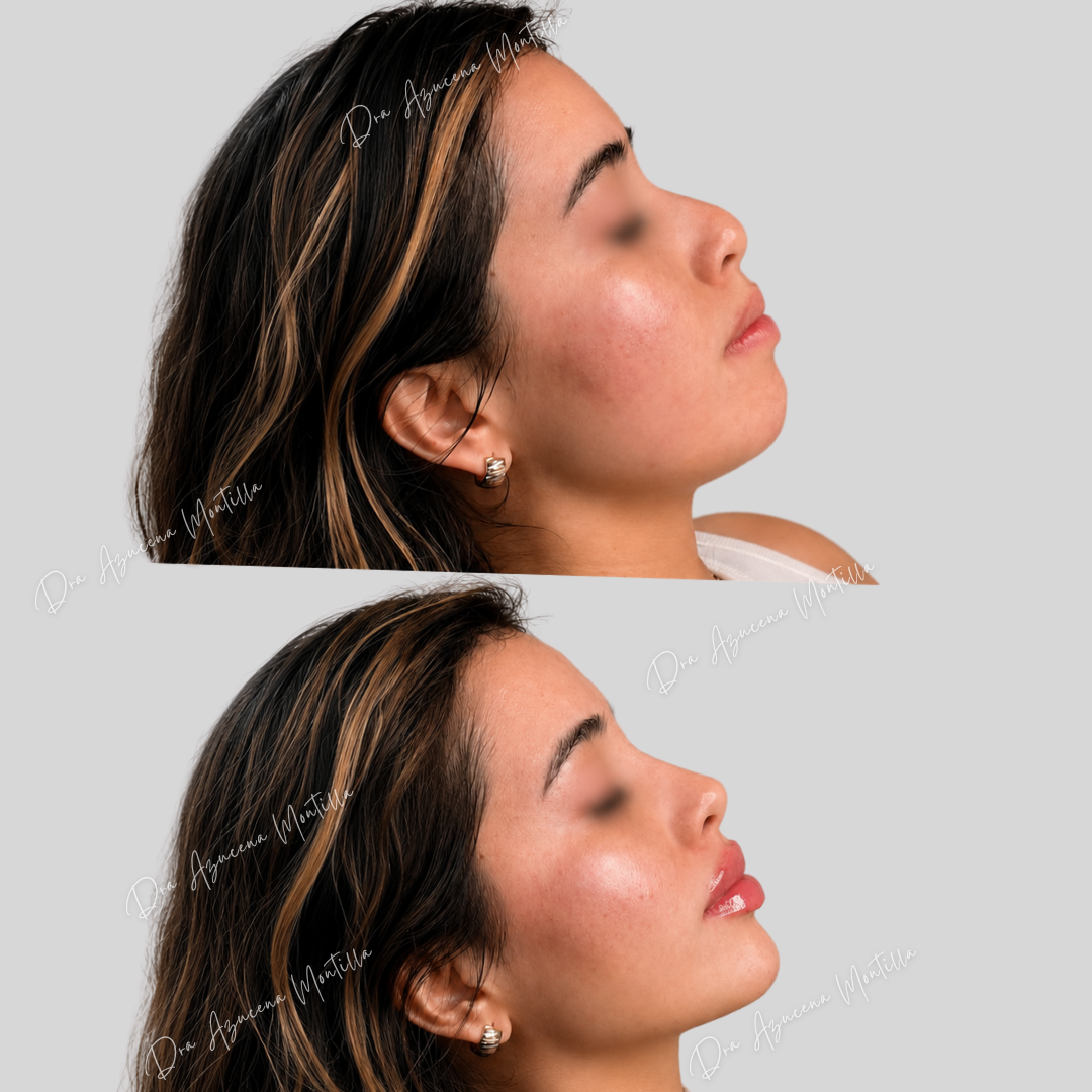 Armonización facial con ácido hialurónico en Padre Hurtado — Dra. Azucena Montilla