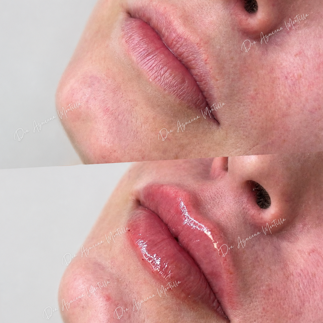 Volumen labial con ácido hialurónico en Padre Hurtado — Dra. Azucena Montilla