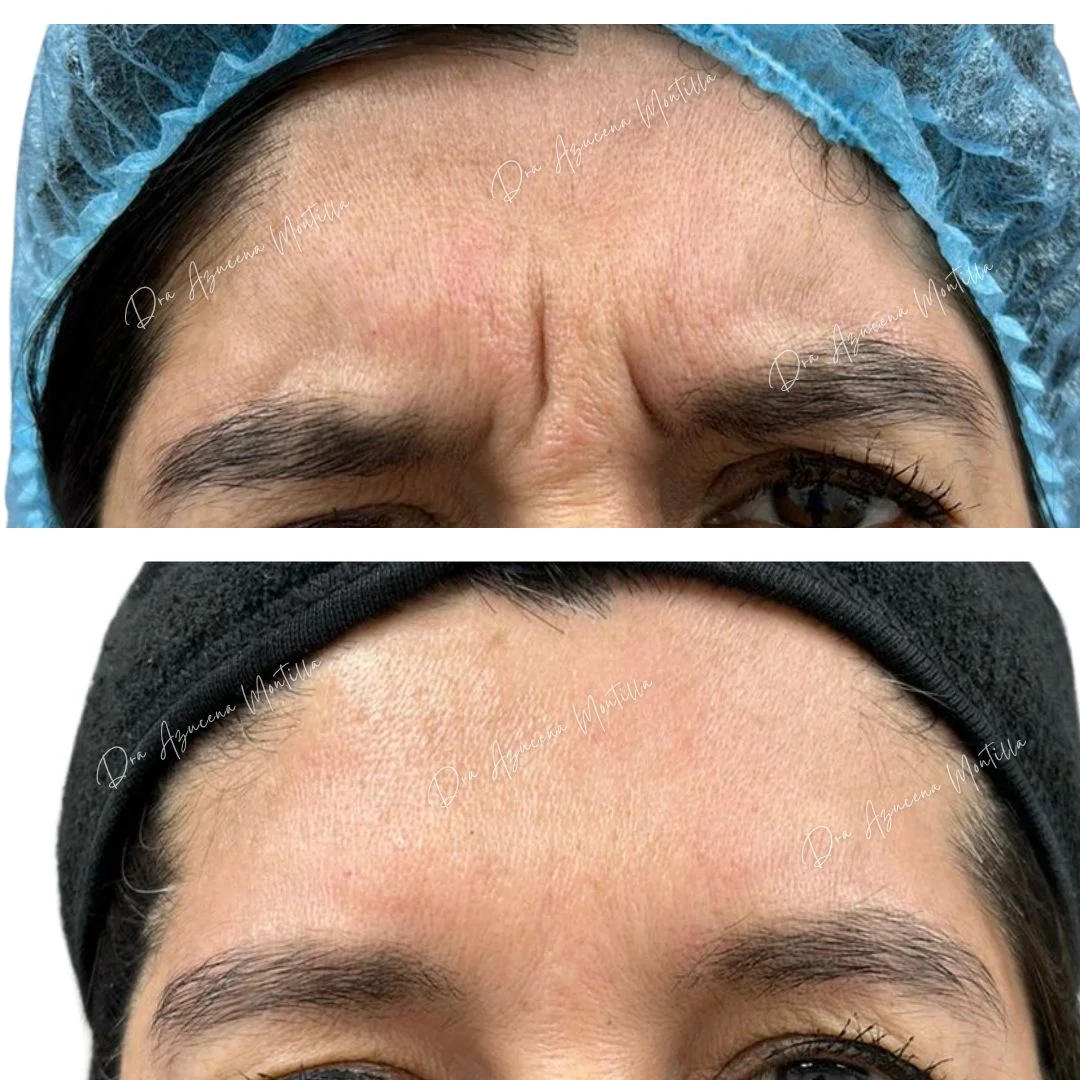 Resultado botox Padre Hurtado — Dra. Azucena Montilla