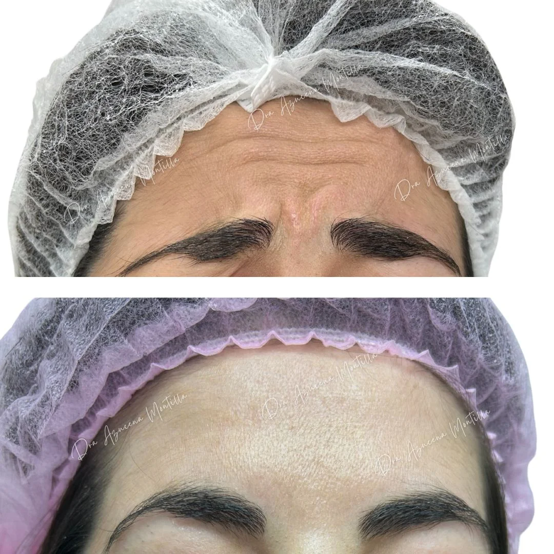Resultado botox Padre Hurtado — Dra. Azucena Montilla
