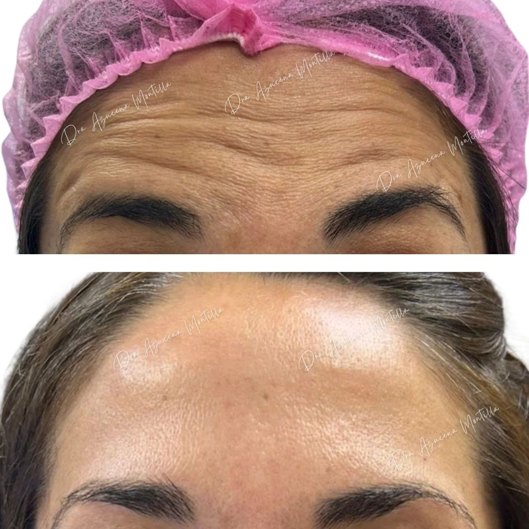 Resultado botox Padre Hurtado — Dra. Azucena Montilla