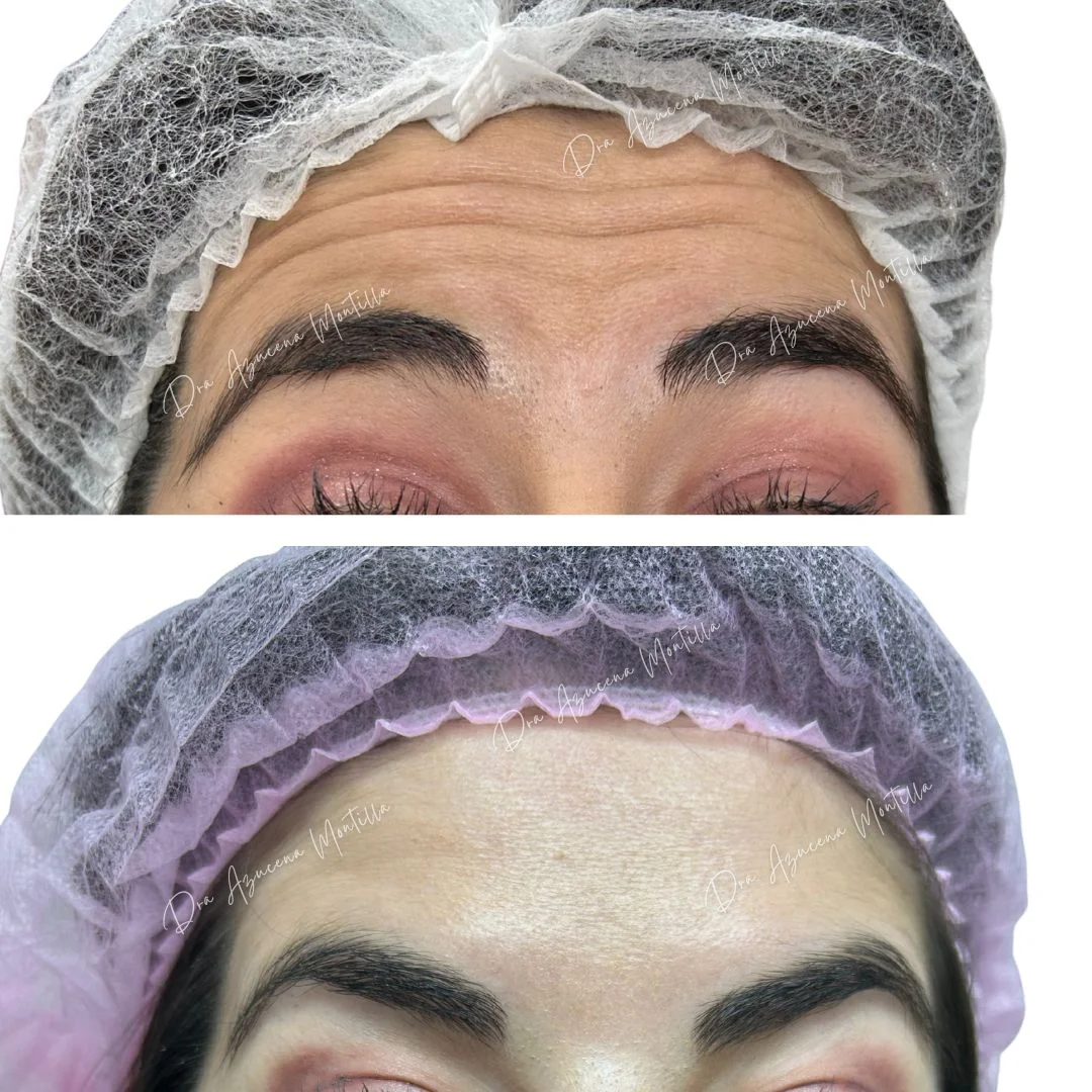Resultado botox Padre Hurtado — Dra. Azucena Montilla