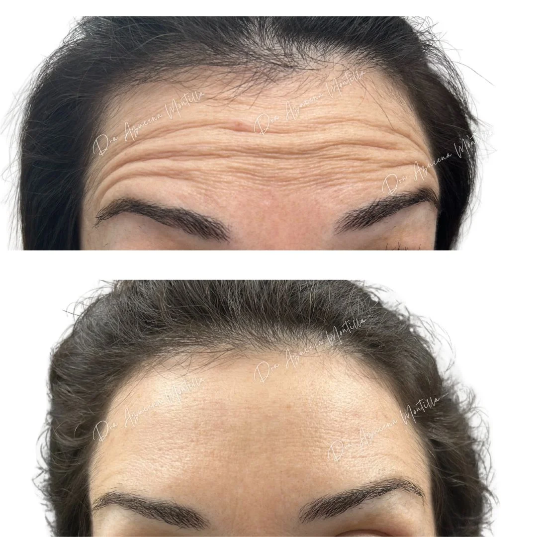 Resultado botox Padre Hurtado — Dra. Azucena Montilla